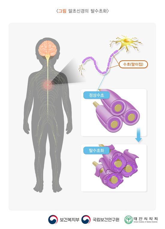 말초신경의 탈수초화