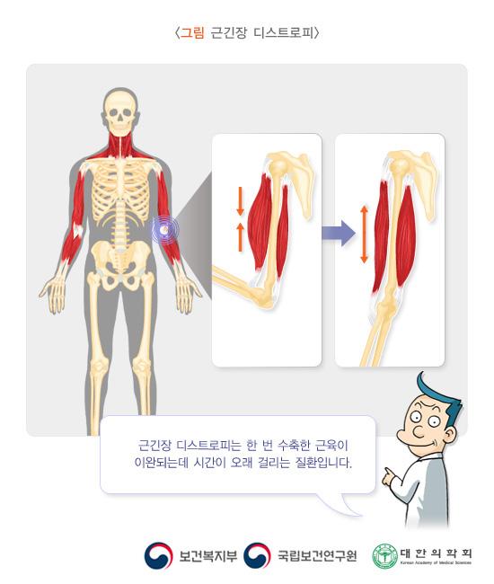 근긴장 디스트로피