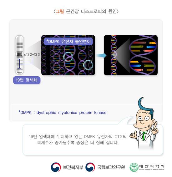 근긴장 디스트로피의 원인
