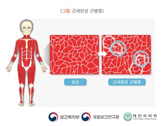 근세관성 근병증. 정상과 근세관성 근병증의 골격근세포 비교 이미지. 보건복지부, 국립보건연구원, 대한의학회