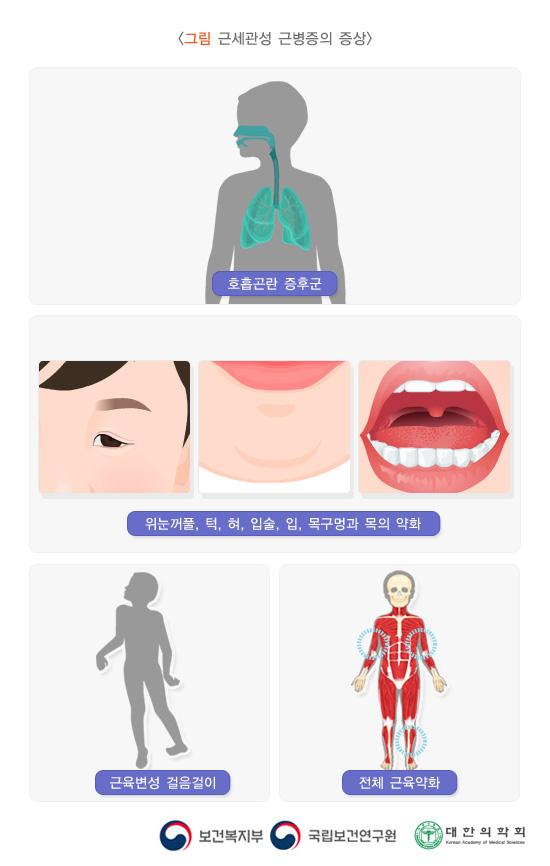 그림 근세관성 근병증의 증상. 호흡곤란 증후군. 위눈커풀, 턱, 혀, 입술, 입, 목구멍과 목의 약화. 근육변성 걸음걸이, 전체 근육약화. 보건복지부, 국립보건연구원, 대한의학회