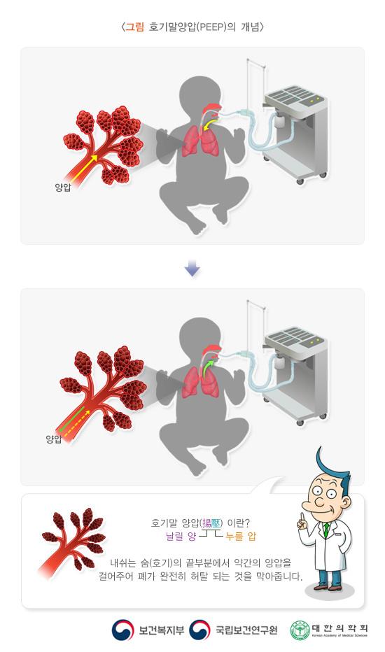 그림 호기말양압(PEEP)의 개념. 양압> 양입. 호기말 양압이란? 날릴 양, 누를 압. 내쉬는 숨(호기)의 끝부분에서 약간의 양압을 걸어주어 폐가 완전히 허탈 되는 것을 막아줍니다.