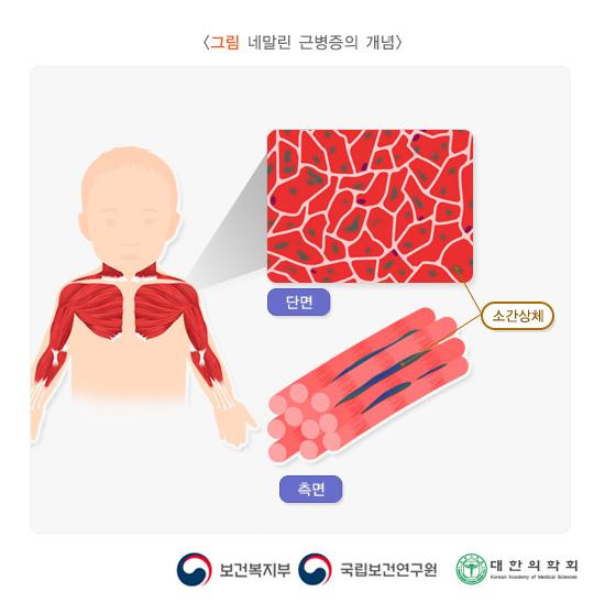 그림 네말린 근병증의 개념. 네말린 근병증 근육의 측면과 소간상체 단면을 보여주는 그림. 보건복지부, 국립보건연구원, 대한의학회