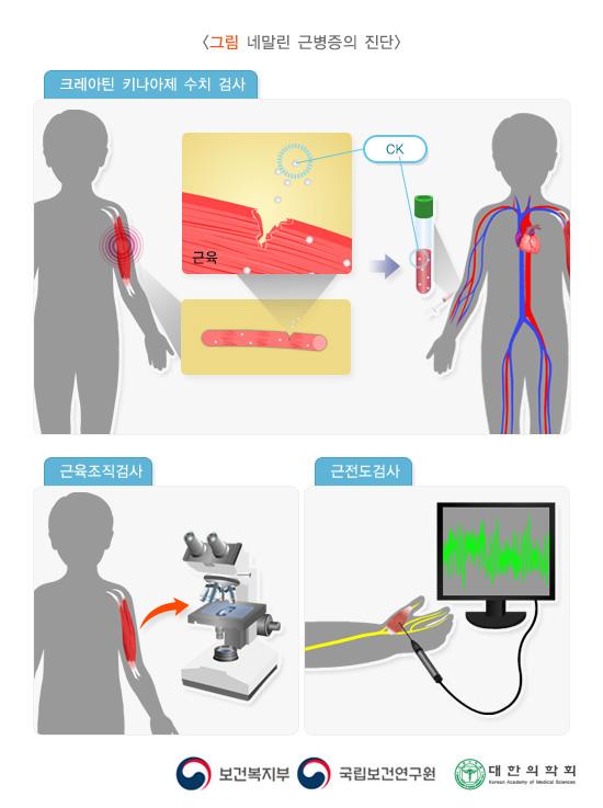 그림 네말린 근병증의 진단. 크레아틴 키나아제 수치 검사. 근육조직검사, 근전도검사. 보건복지부, 국립보건연구원, 대한의학회