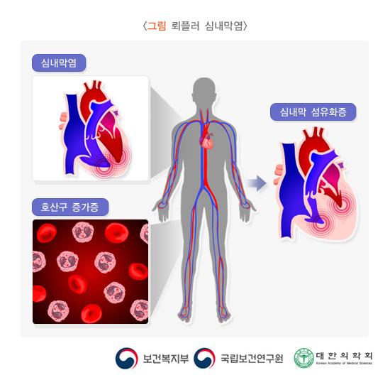 뢰플러 심내막염