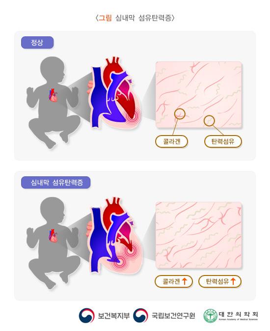 그림. 심내막 검유탄력증. 정상 아이 심내막 콜라겐과 탄력섬유 예시 이미지와 심내막 섬유탄력증인 아이의 증가된 콜라겐과 탄력섬유 예시 이미지. 보건복지부, 국립보건연구원, 대한의학회.