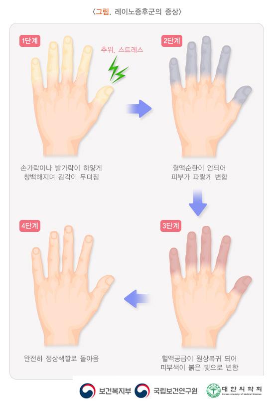 레이노증후군의 증상