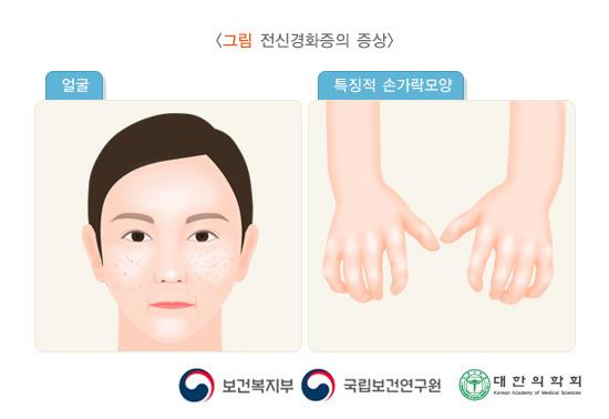 전신경화증의 증상