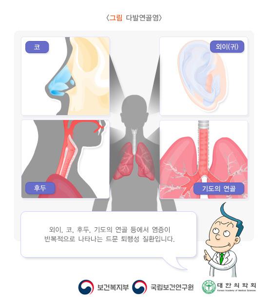 다발연골염은 외이, 코, 후두, 기도의 연골 등에서 염증이 반복적으로 나타나는 드문 퇴행성 질환입니다. 보건복지부, 국립보건연구원, 대한의학회.