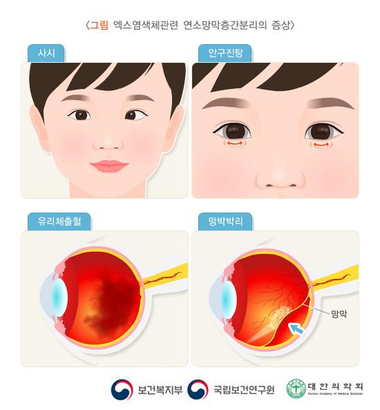 엑스 염색체관련 연수망막증간분리의 증상