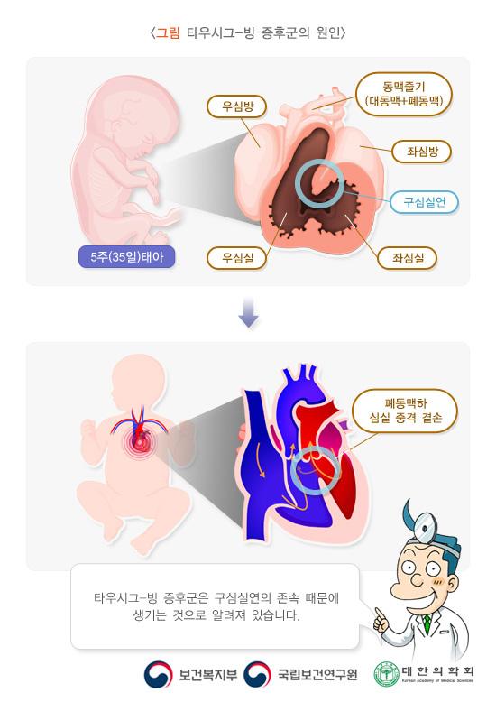 타우시그 빙 증후군의 원인
