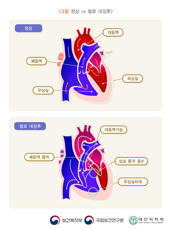 정상 vs 팔로 네증후