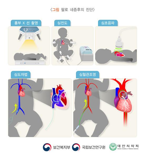 팔로 네증후의 진단