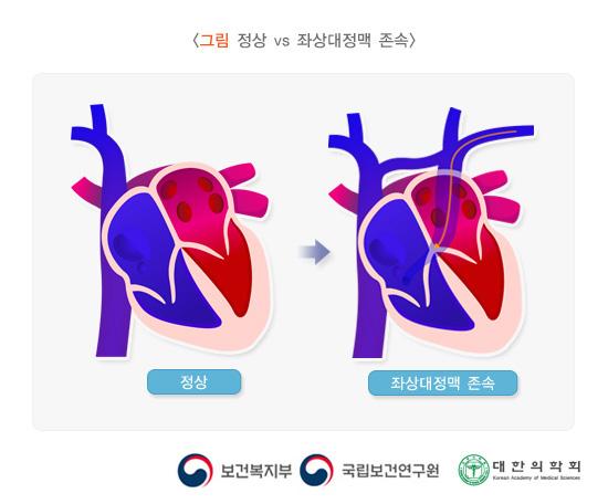 정상 vs 좌상대정맥 존속