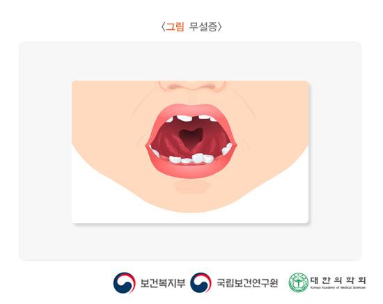 무설증
