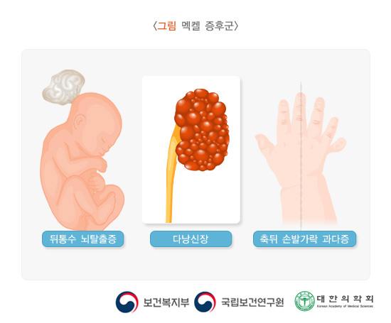 멕켈 증후군