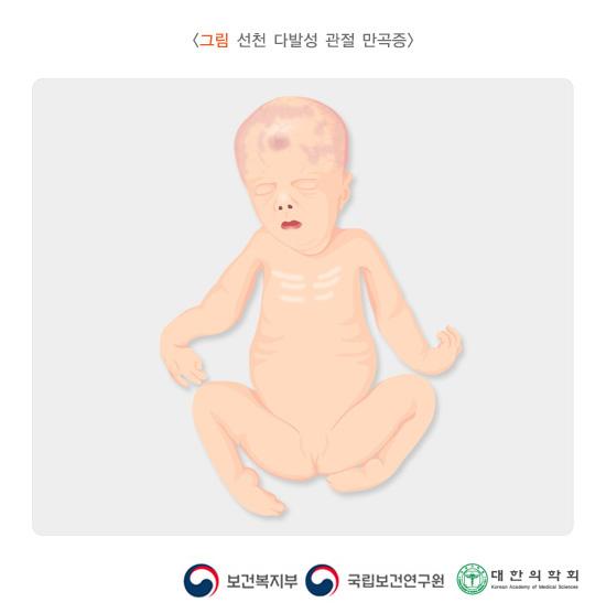 선천 다발성 관절 만곡증