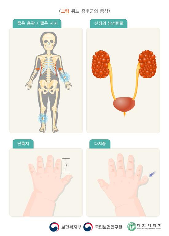 쥐느 증후군의 증상