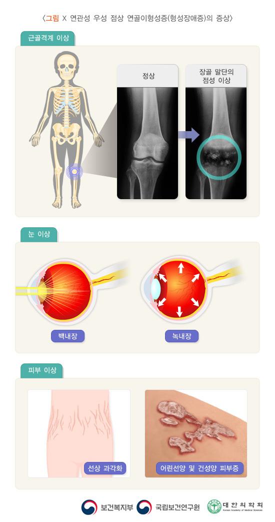 X 연관성 우성 점상 연골이형성증(형성장애증)의 증상