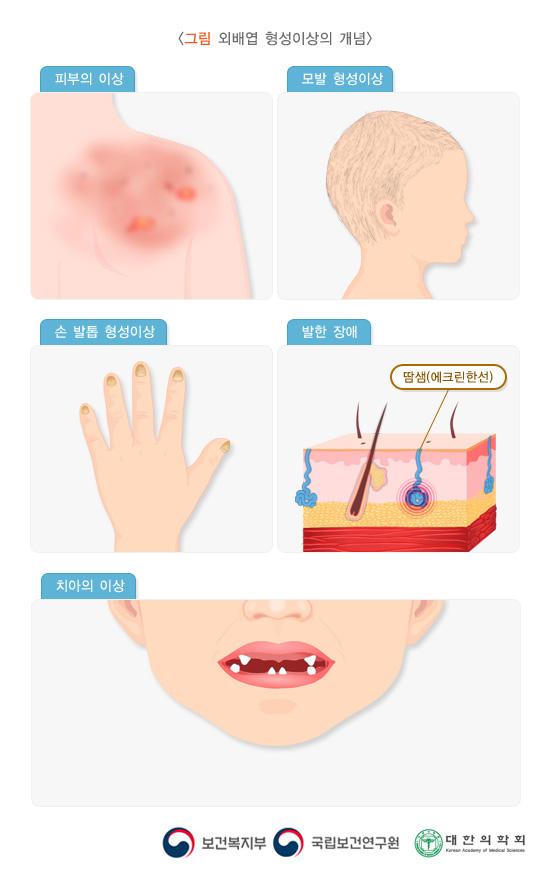 외배엽 형성이상의 개념/ 피부의 이상,모발 형성이상, 손 발톱 형성이상, 발한장애, 치아의 이상