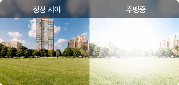 주맹증 주맹증
