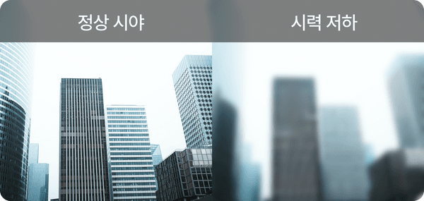 시력저하 시력저하